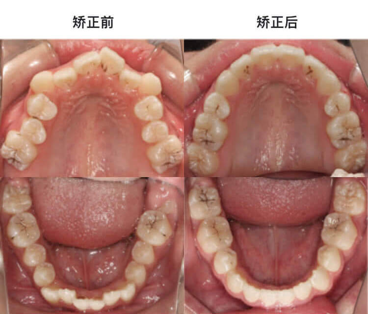 传统金属托槽拔牙矫正,解决牙齿拥挤