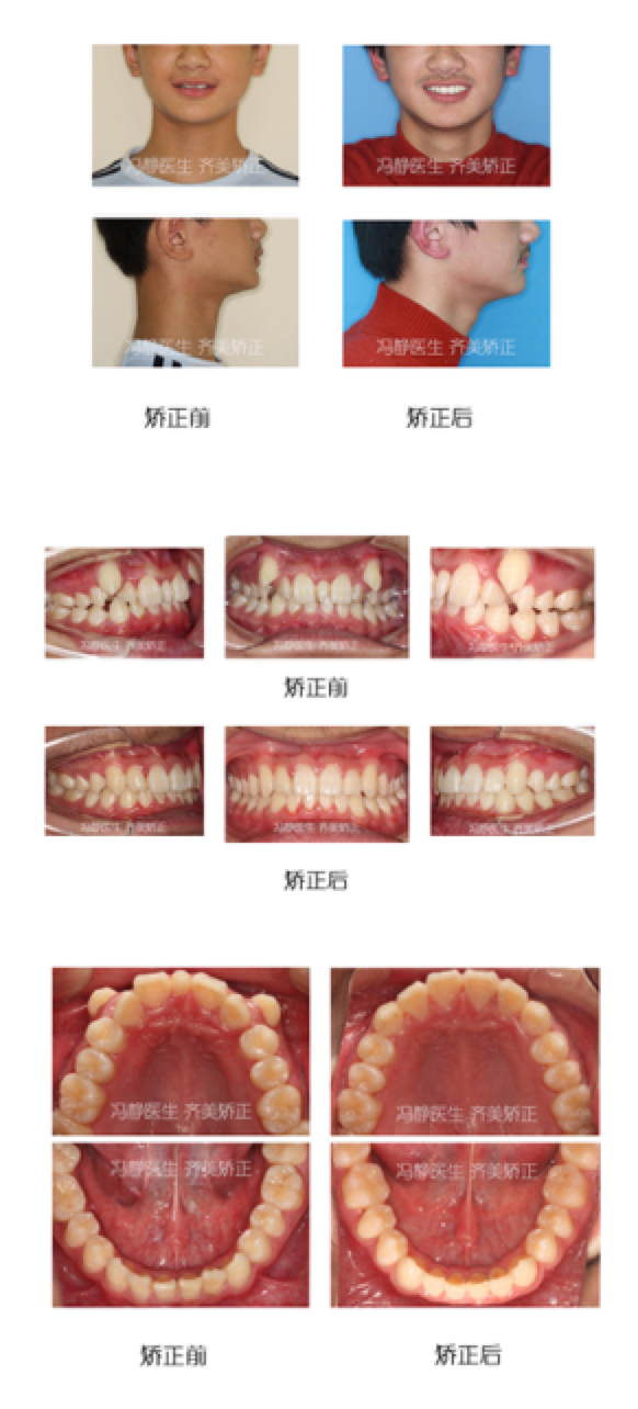 让笑容自由飞扬:虎牙多生牙矫正