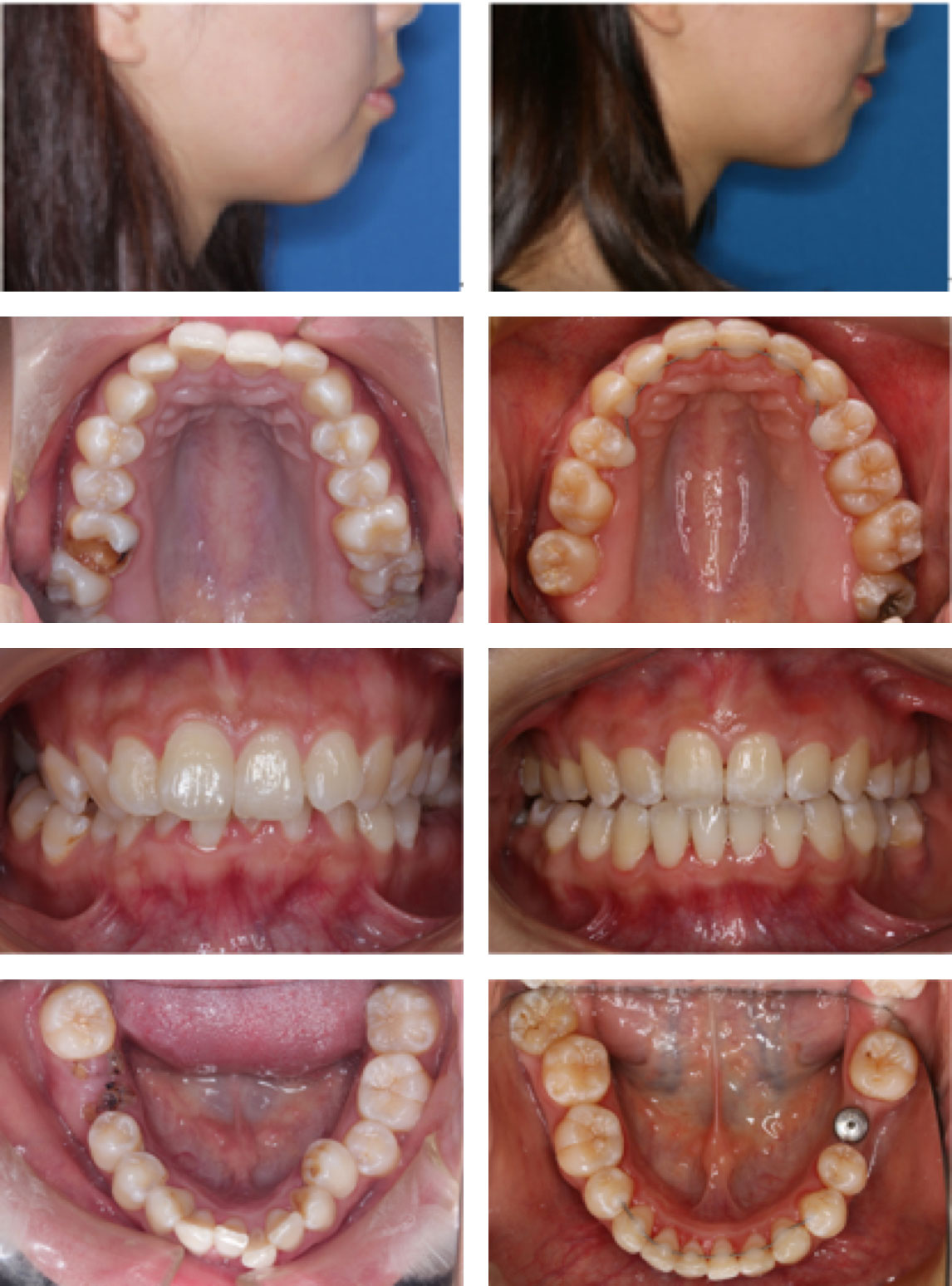 采用了舌侧矫治器,上颌及下颌个拔两颗牙,排齐上下牙齿,关闭拔牙间隙