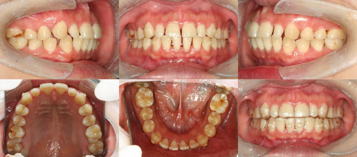 主要问题为牙列间隙,过小牙,牙槽骨Ⅰ°吸收.