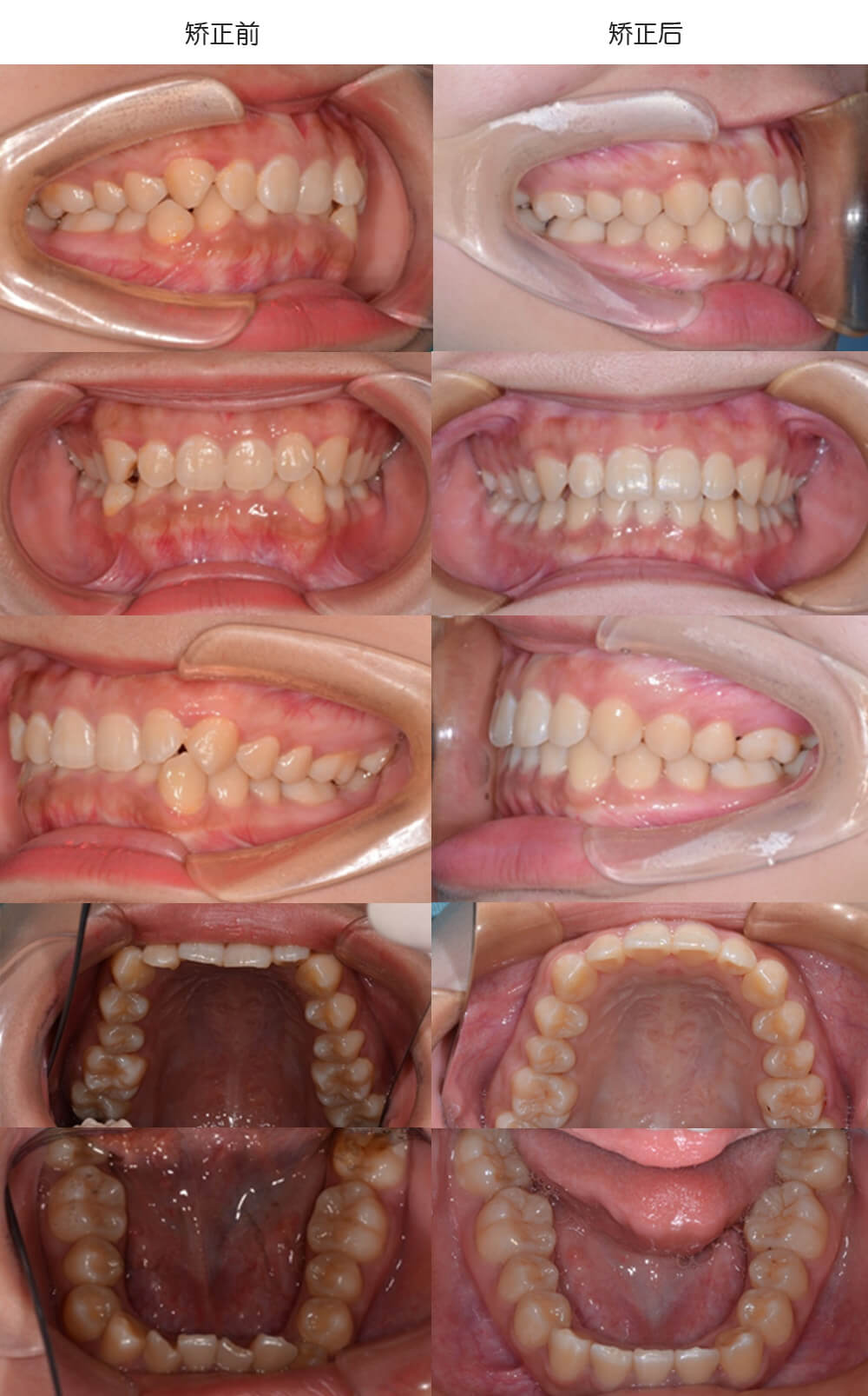 上海牙齿矫正医学类型:深覆合 牙列拥挤矫正方法:隐形矫正 拔牙治疗