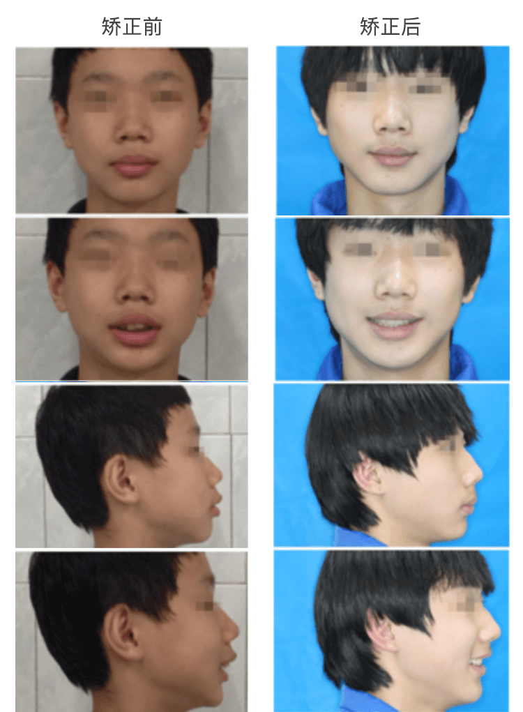 龅牙嘴突矫正,从叛逆少年到阳光大男孩