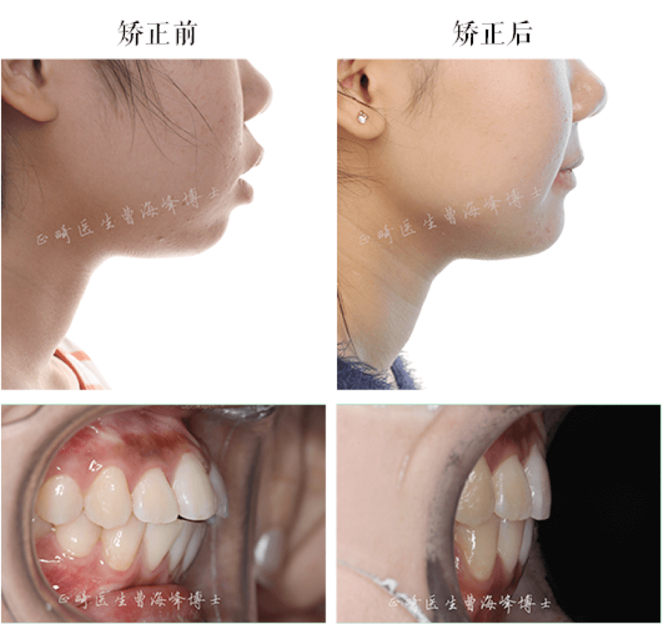 骨性前突 开合,少女牙齿矫正,效果堪比整容!