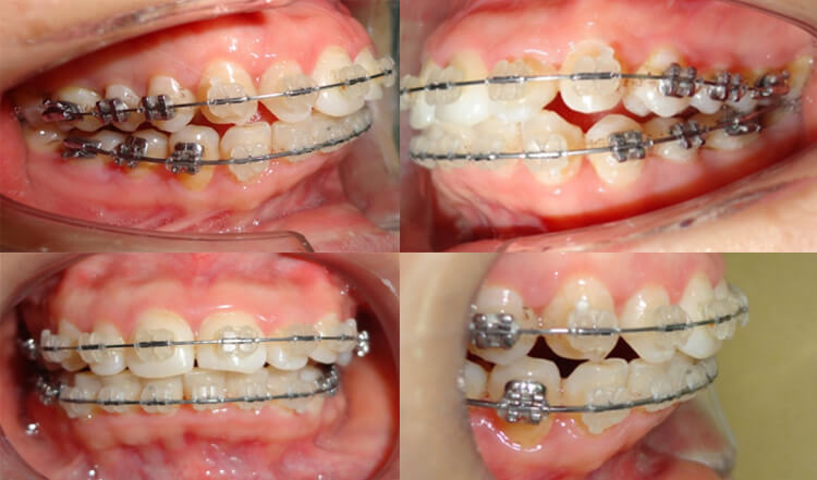 挑战手术!成人骨性双颌前突,牙齿矫正效果惊艳!