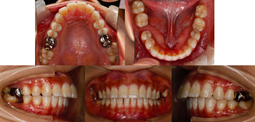 前牙深覆盖,上下牙弓形态不协调,上颌牙弓尖圆形,下颌牙弓卵圆形,由于
