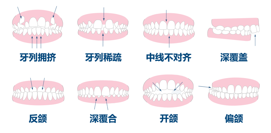 △牙齿畸形类别