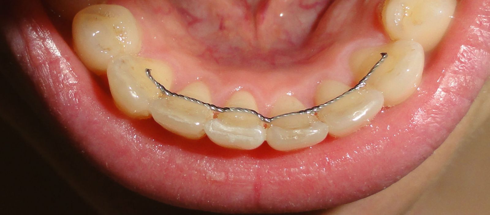 在矫治结束后,医生会制作保持器,以使牙齿稳定在排列良好的新位置上