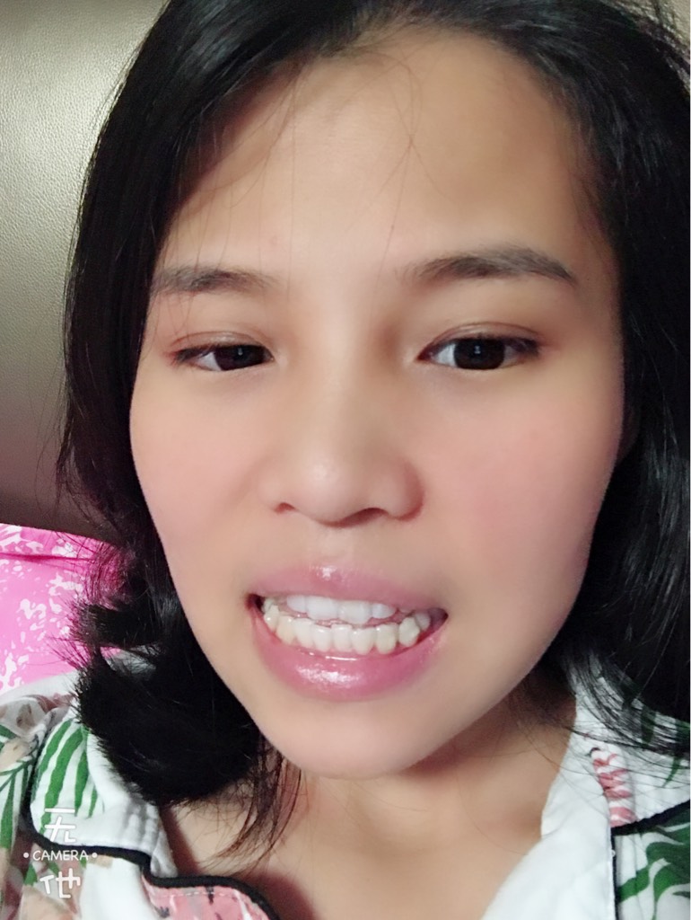 第二副牙套结束