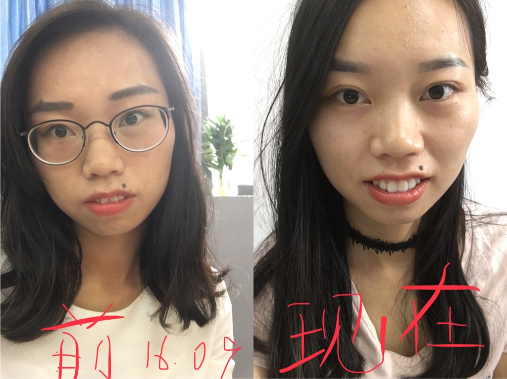 一年记 贝致—专业口腔服务平台,让你变美的牙套交流社区