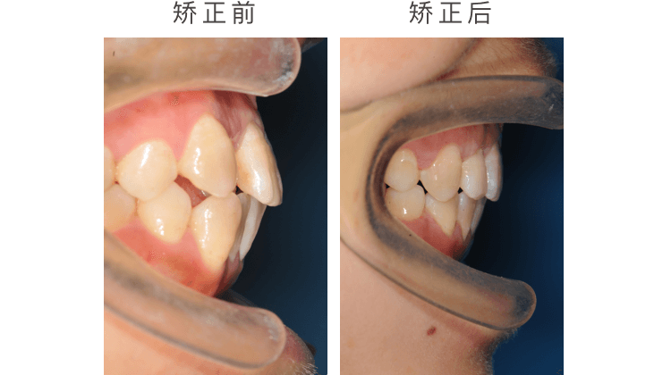 凸嘴牙齿矫正效果图图片