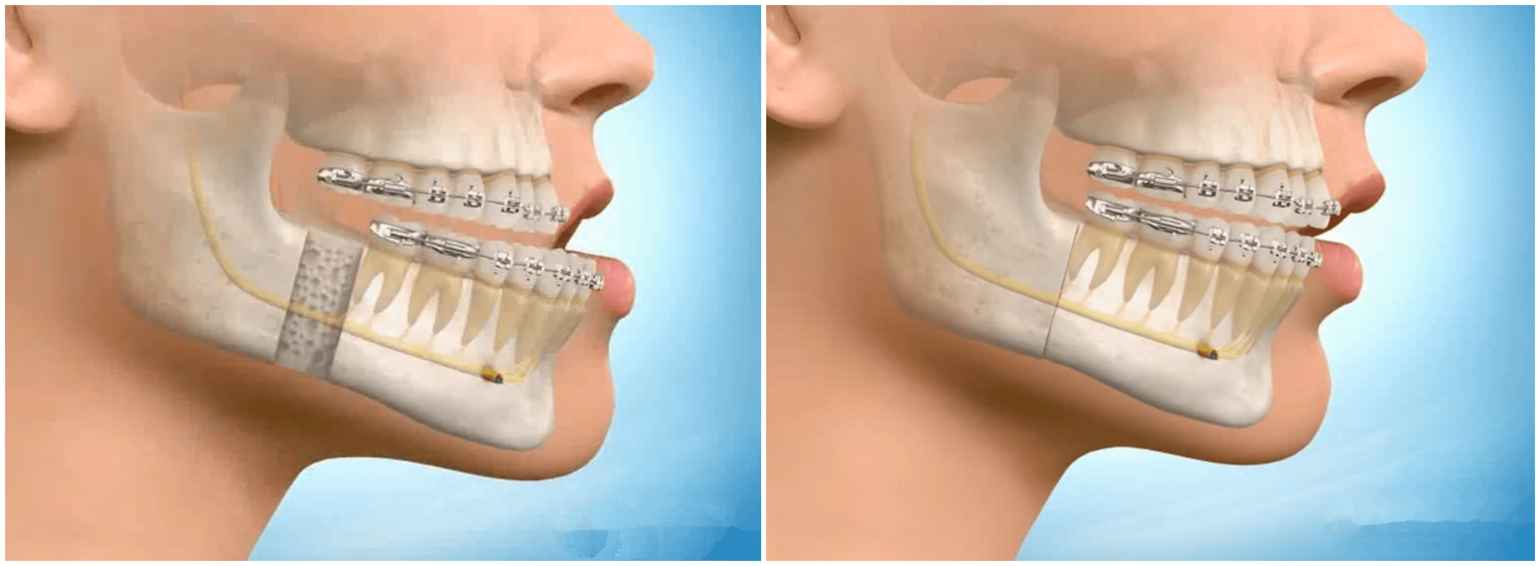 正颌手术示意图