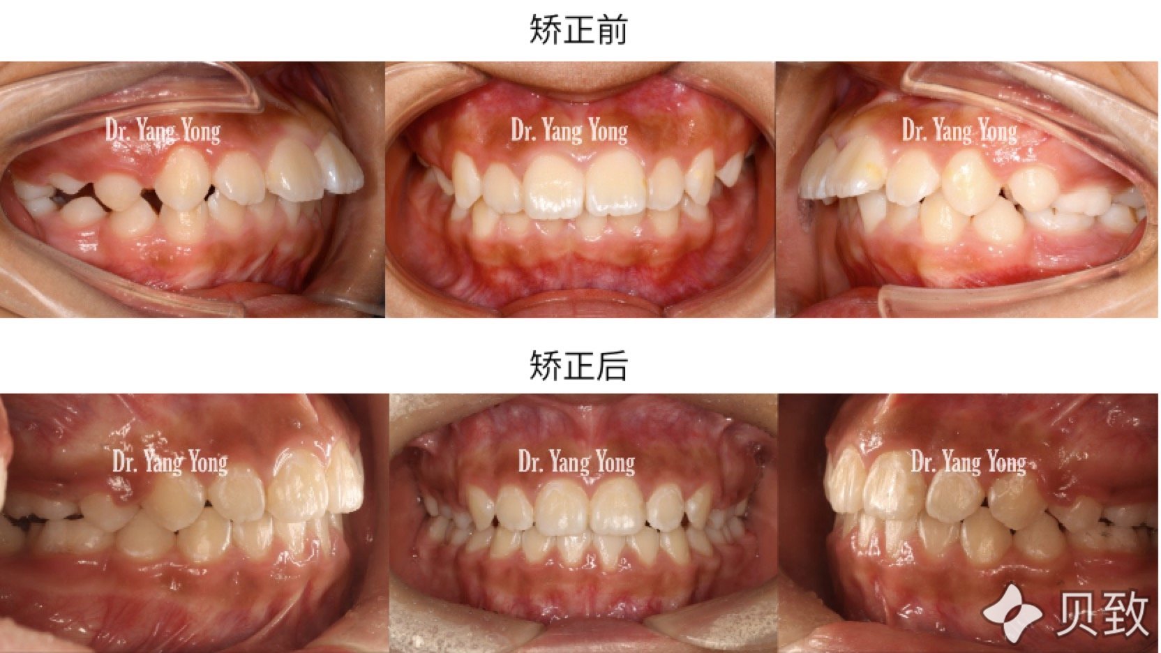 深覆蓋深覆合改善,牙齒排列整齊,咬合關係穩定良好.