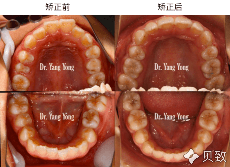 嘴凸缩下巴遗传青少年矫正避免成年整形