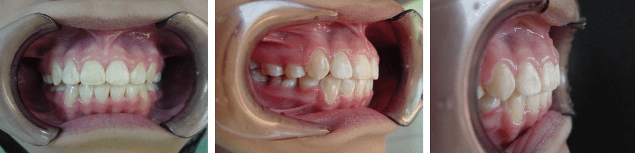 轻度骨性龅牙图片图片