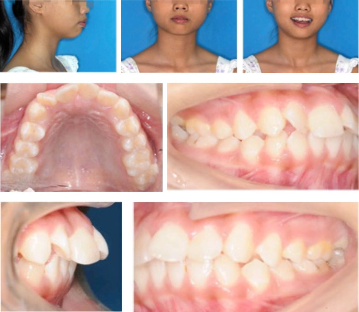 牙齿矫正该怎么区分是骨性嘴突还是牙性嘴突的？ - 知乎