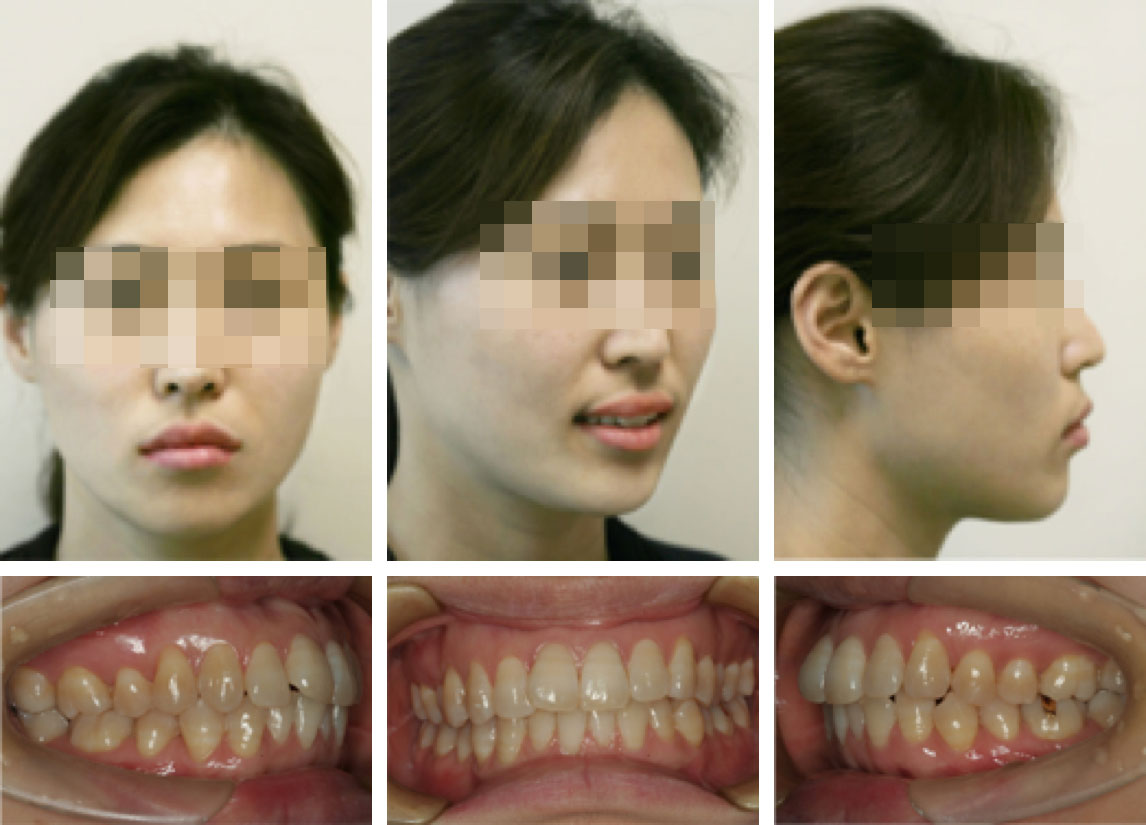 【正颌手术案例分享】双颌前突矫正术+颏成型术前和术后15天对比（照片为案例，我院拥有肖像使用权） - 好大夫在线