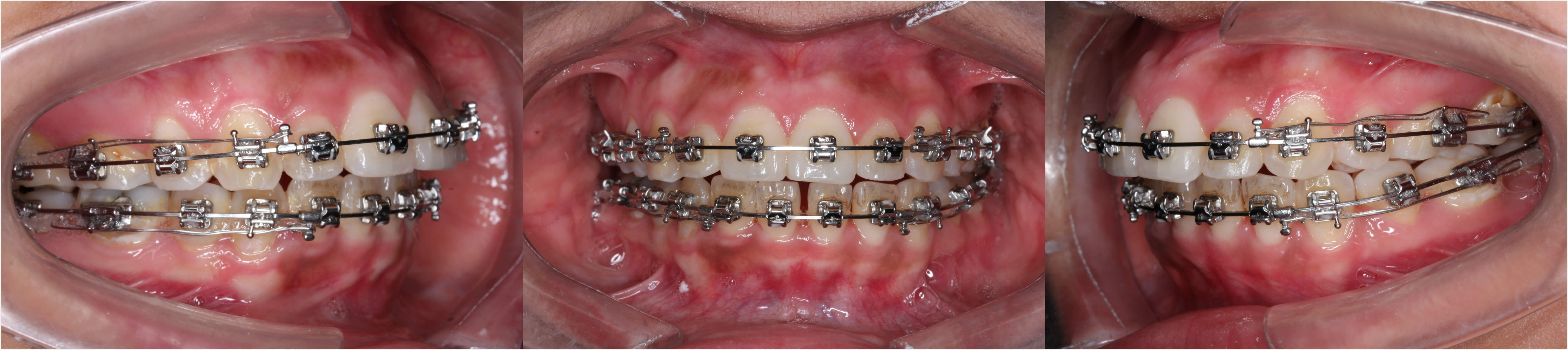 广州牙齿矫正杨露正畸案例：前牙散在间隙、骨性下颌前凸正畸案例解析 - 哔哩哔哩