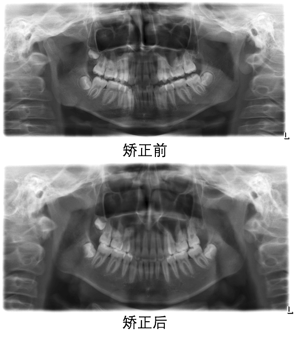 儿童面部x光 牙齿图片