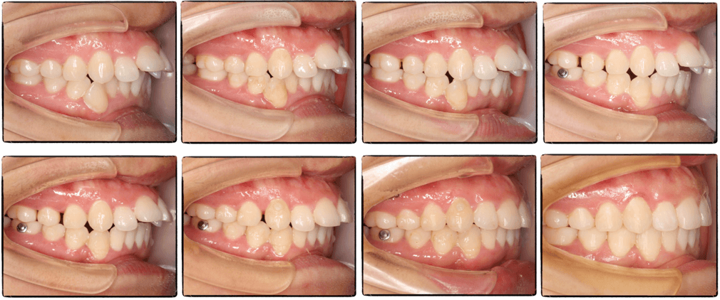牙齒擁擠必須拔牙?齙牙女生的不拔牙隱形矯正