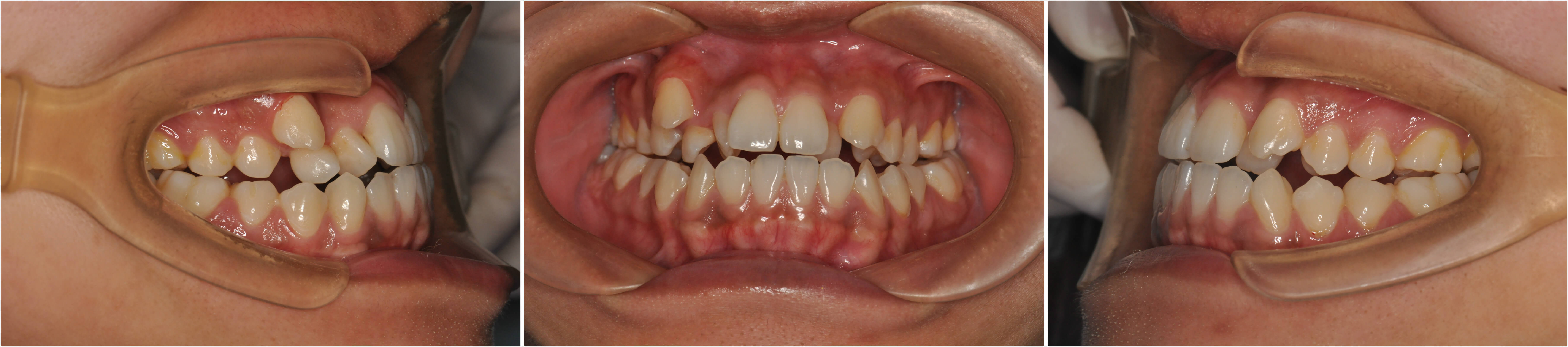 骨性反颌（轻微地包天）-对刃、中线不齐、牙齿缝隙大-26岁男-正畸记录 - 知乎