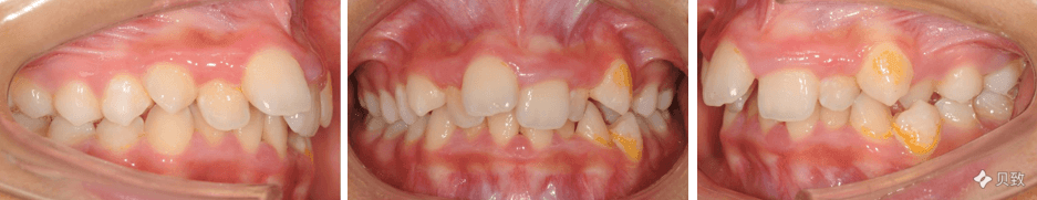 从犬牙差互到齿如编贝 18个月解除牙齿拥挤