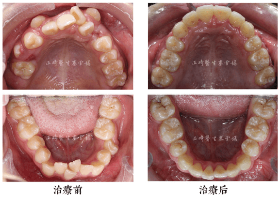 拔牙矯正重塑整齊牙列 - 貝致案例庫 - 貝致