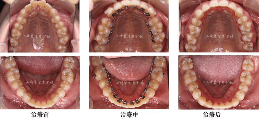 舌侧隆突图片