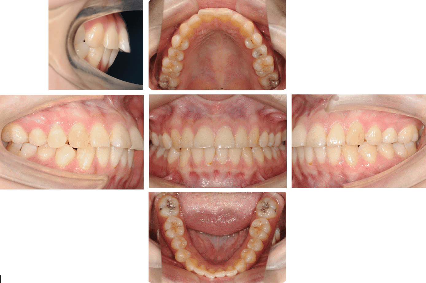 矫正牙齿到底可以改变什么？