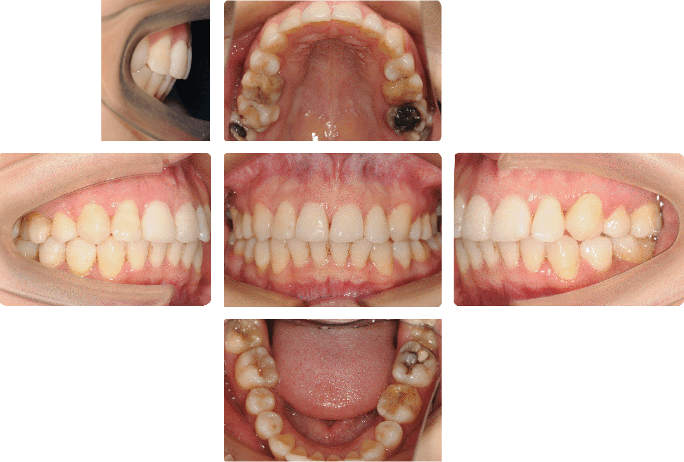 正畸根尖区牙根外吸收的风险因素及其临床处理建议的专家共识