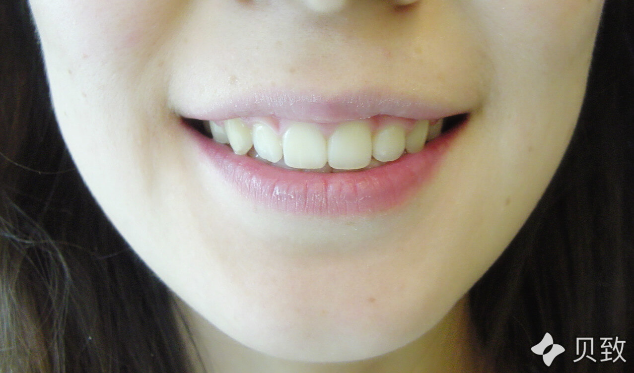 牙齿整齐可以有多美成人非常规拔牙矫正