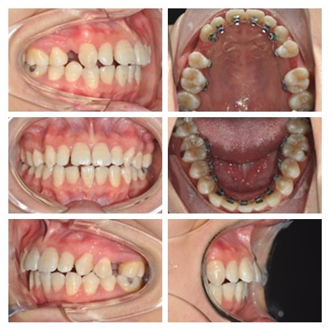 牙齿矫正牙列拥挤图片图片