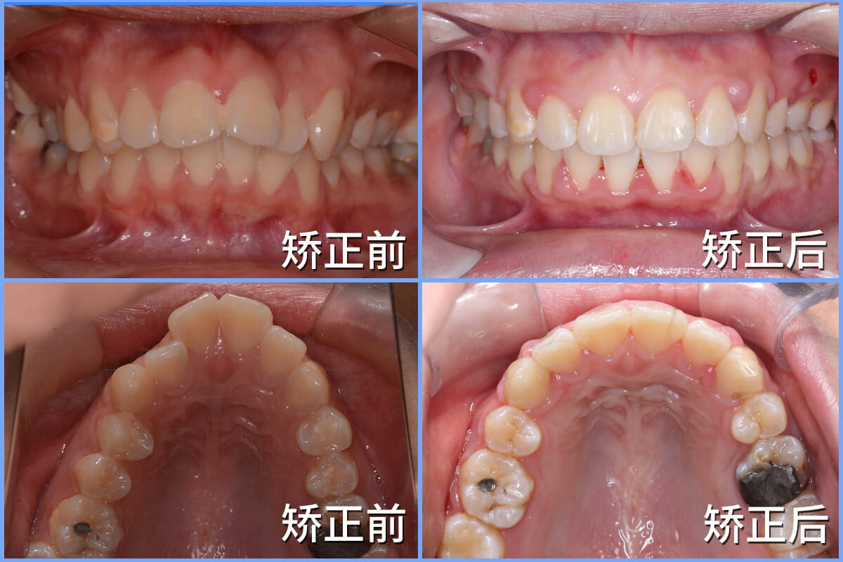 正畸前后脸型对比图片