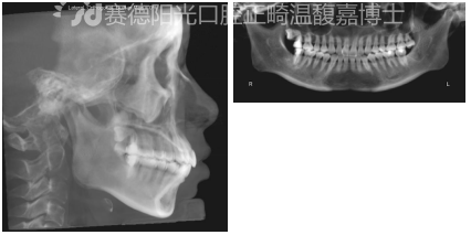 矫正前