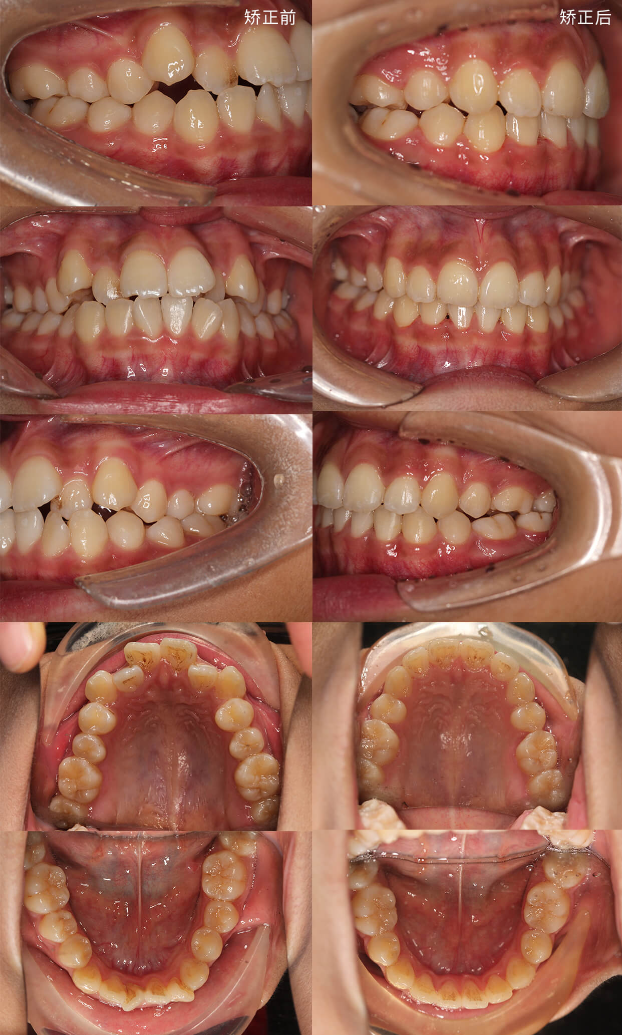 虎牙矫正后嘴唇变化图图片