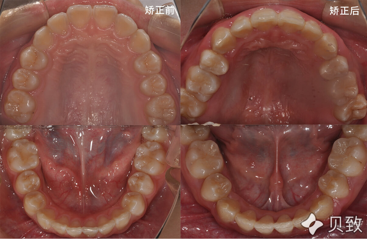 矫正前后口内像对比