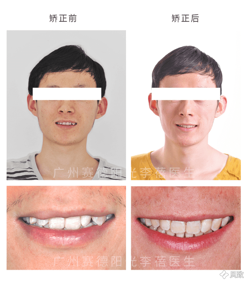 牙齿重度拥挤 虎牙男孩矫正记