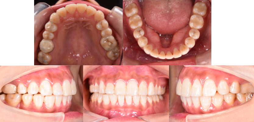 牙齿排列整齐,上颌牙弓形态明显改善,上下颌牙弓协调,深覆盖也得到了