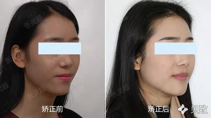 牙齿不齐的自卑少女 矫正后绽放自信笑颜