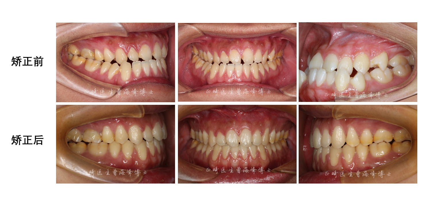 上海牙齿矫正医学类型:反合矫正方法:隐形矫正, 正畸正颌治疗周期:16