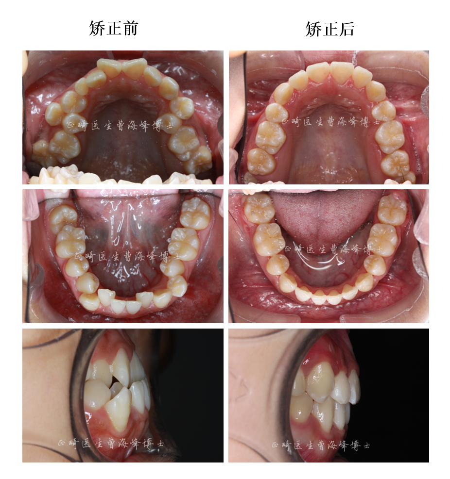 骨性地包天,花季少女的不手术案例