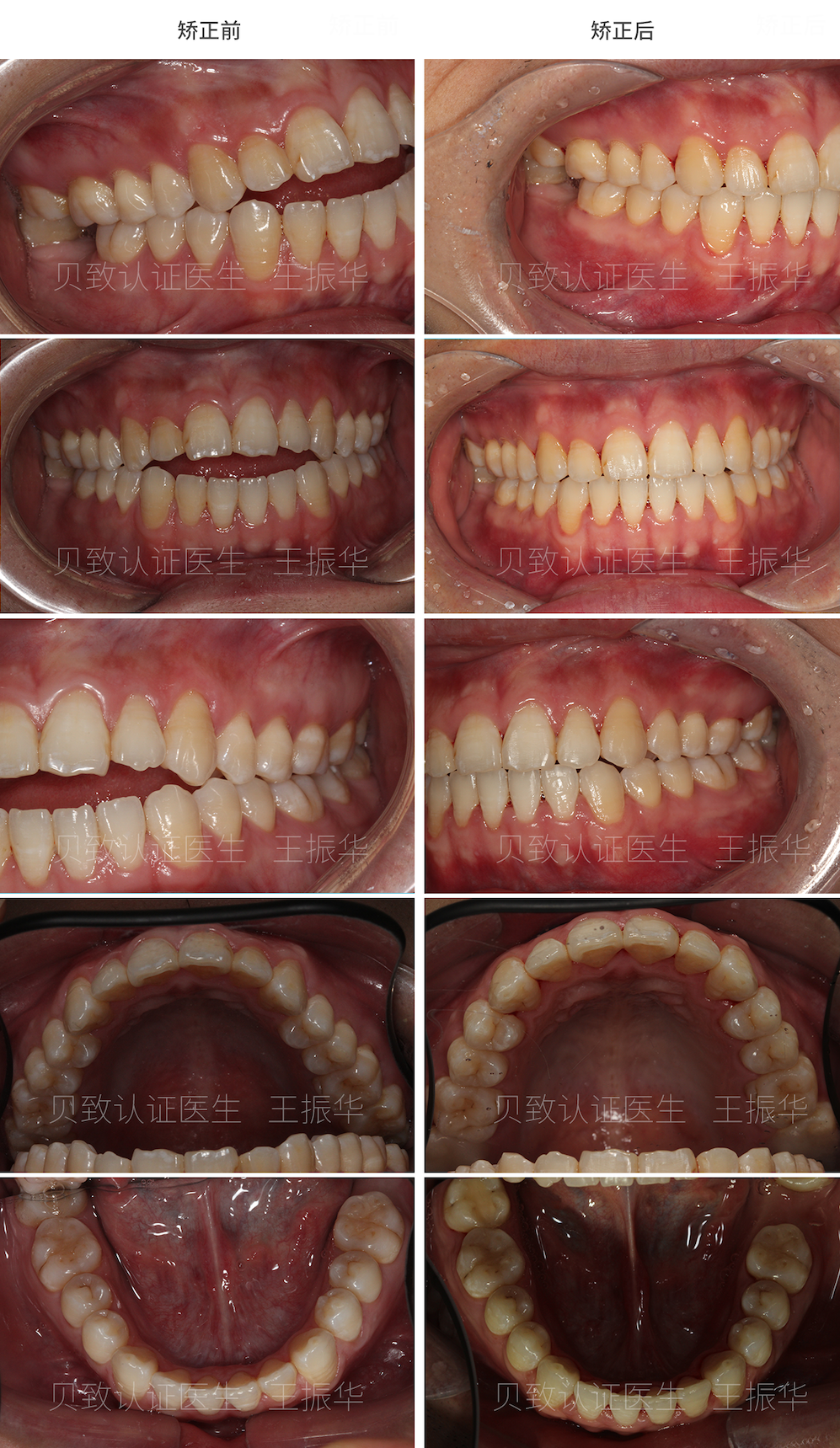 矫正治疗周期:24个月治疗前后面像对比正常人的前牙能够行使切割功能