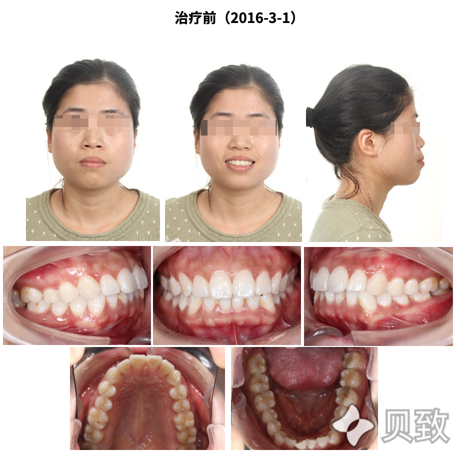 戴牙套如整容 甩掉嘴突憨厚感
