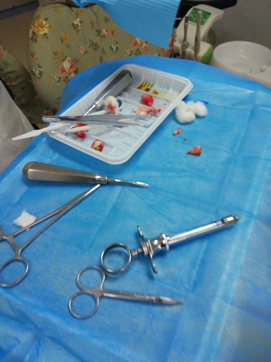 牙牙日记 拔牙篇 贝致——专业口腔服务平台,让你变美的牙套交流社区