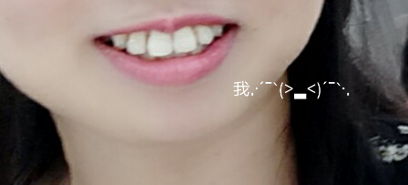 有木有笑起来上唇都没了的小伙伴😂 贝致——专业口腔服务平台，让你变美的牙套交流社区