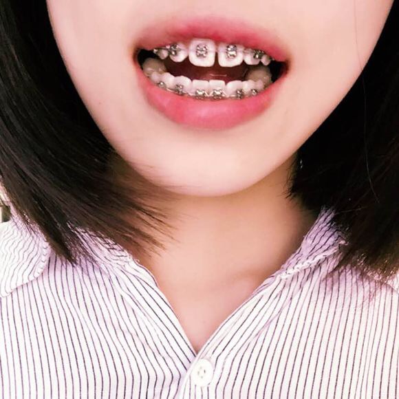 戴上牙套的妹子们看过来!