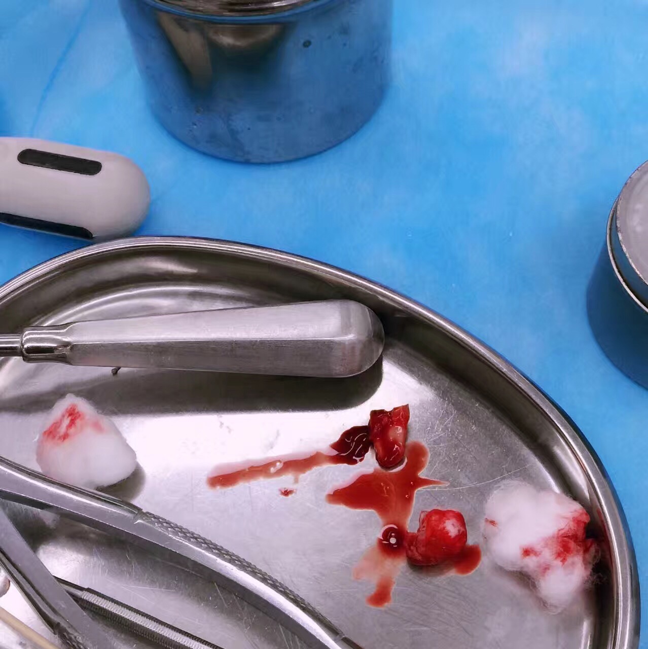 从拔掉虫牙开始