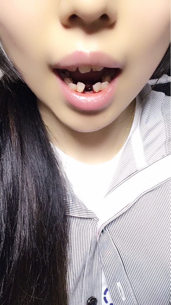 拔了两颗下门牙