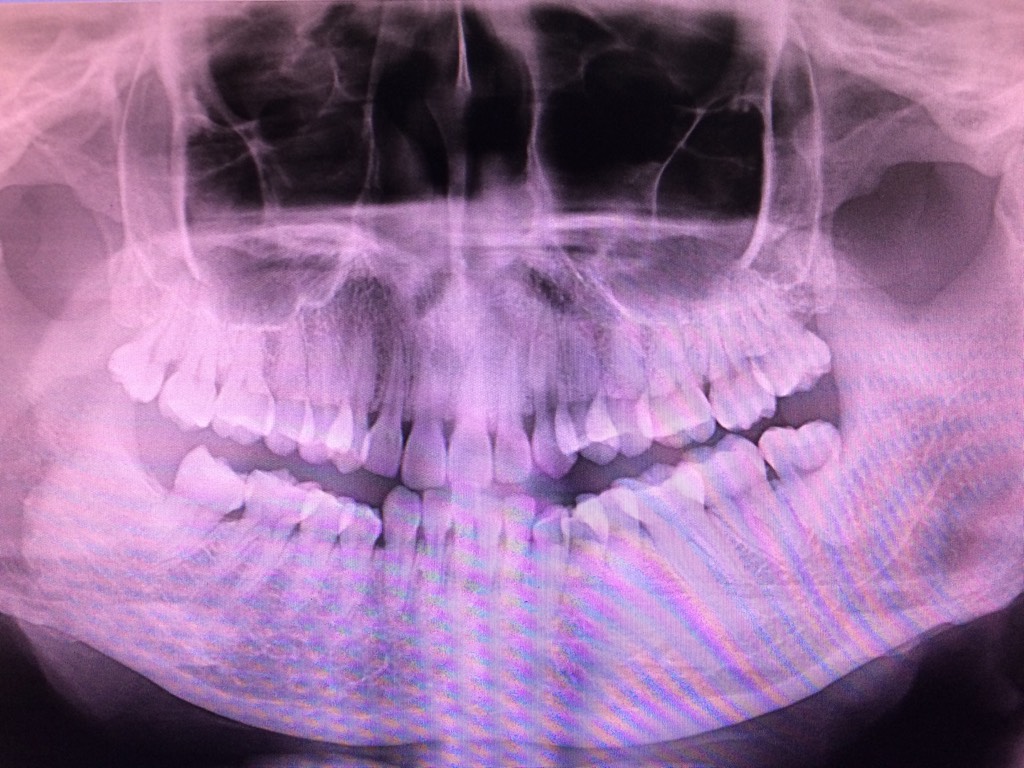上颌牙槽骨厚度不够，做了骨移植。-申太运的博客-KQ88口腔博客