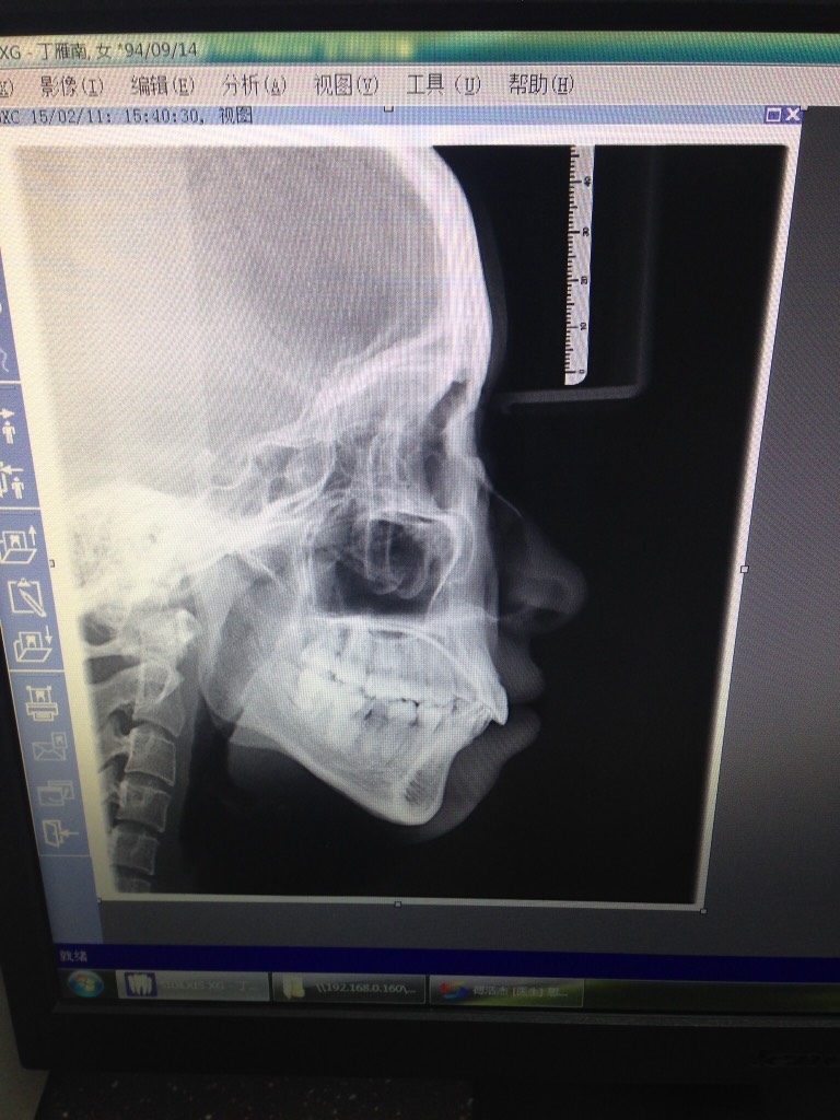 (还没矫正前拍的片～ 上牙突 一笑就是大龅牙)