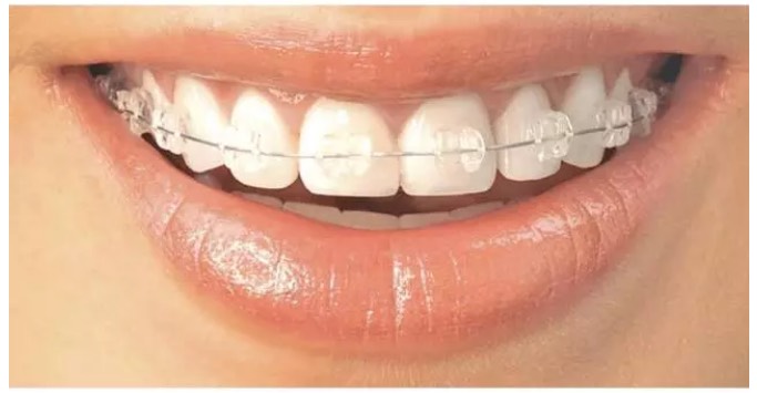 3自锁矫治器 传统钢牙进阶版! 优点:托槽可以直接锁住弓丝.